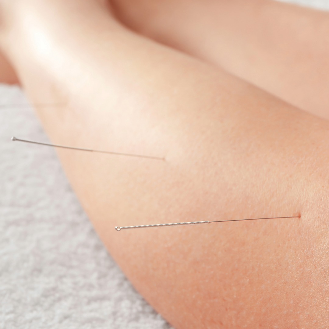 Akupunktur in der Schwangerschaft – Sanfte Unterstützung bei Beschwerden